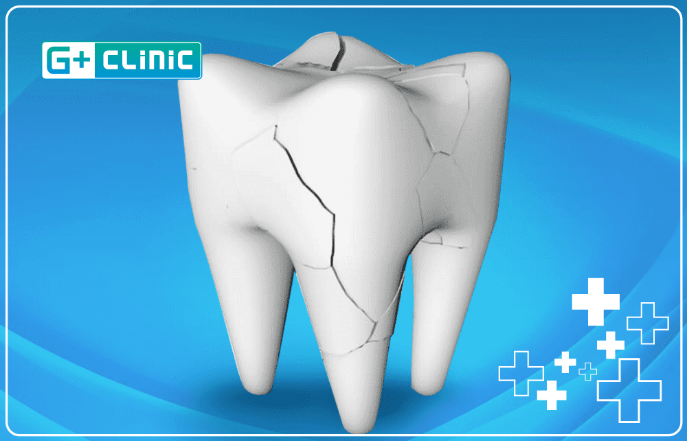 tooth fracture logo