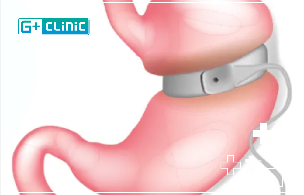 adjustable gastric banding