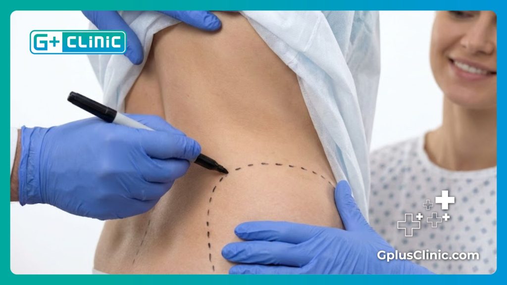 Surgeon marking the area for a perfect BBL result.