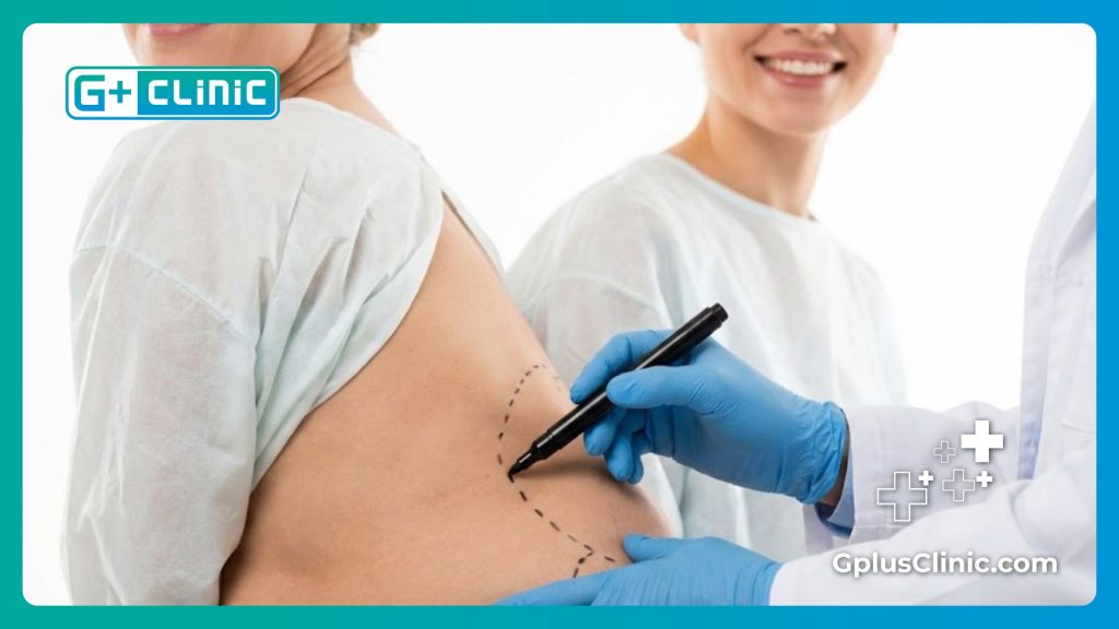 Marquage préopératoire pour le remodelage des fessiers