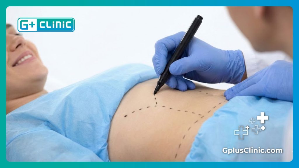 Cirujano marcando guías en el abdomen para la liposucción