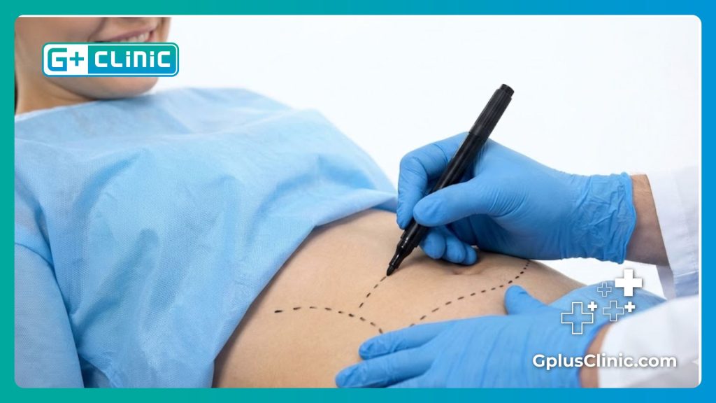 Doctor marking surgical guidelines on patient waist for body contouring procedure