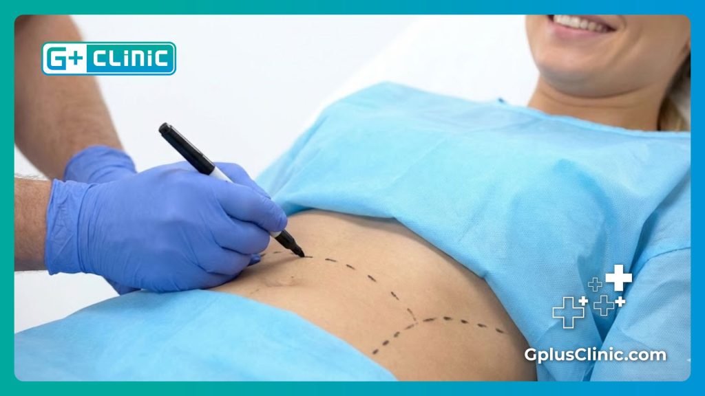 Cirujano realizando marcas preoperatorias en el abdomen