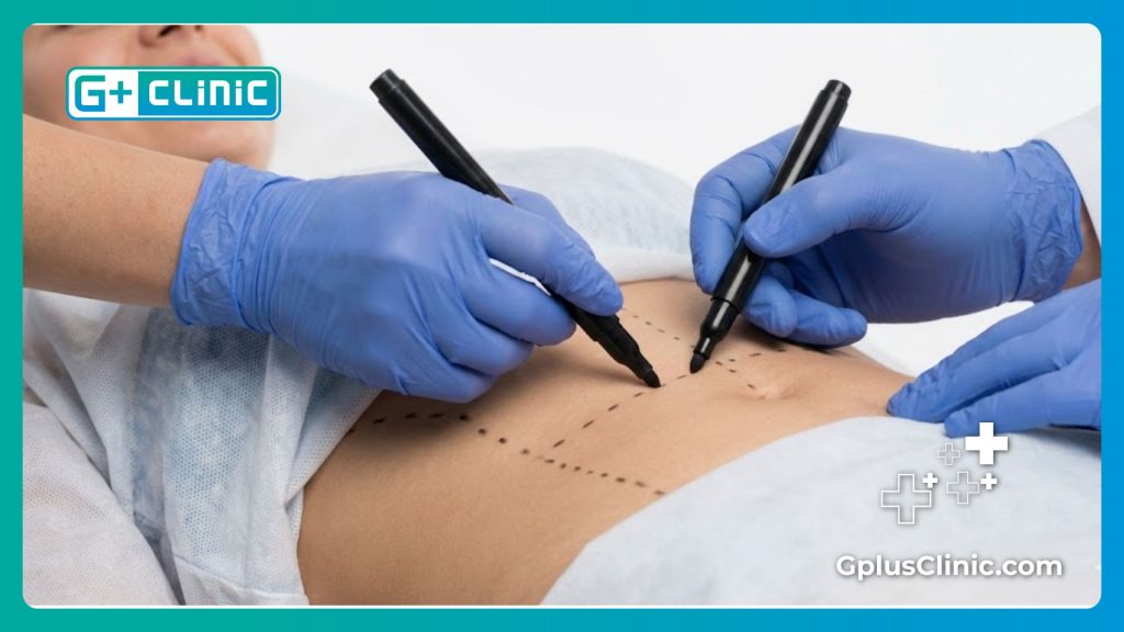 جراح تجميل يرسم خطوط التحديد الجراحي بدقة على بطن المريض