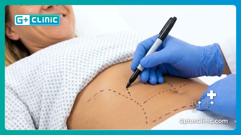 جراح تجميل يرسم خطوط تحديد منطقة البطن قبل عملية الفيزر