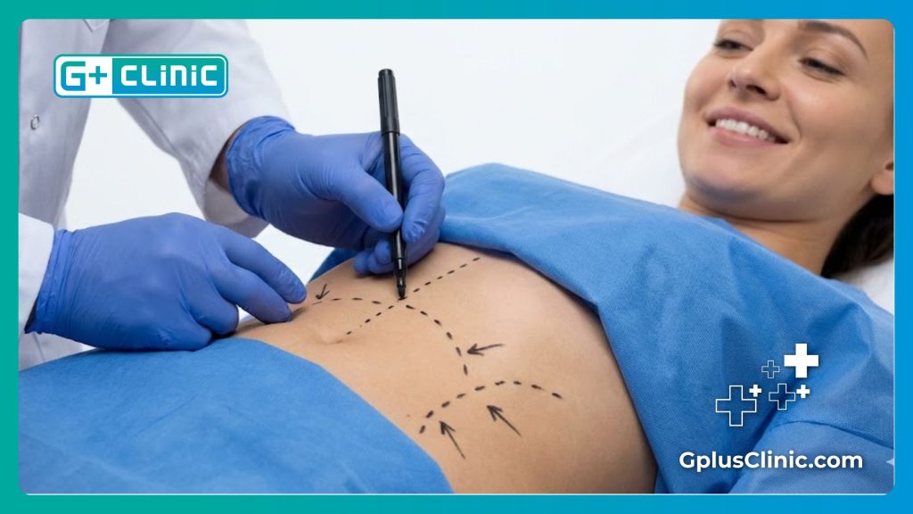 Surgeon marking surgical guidelines on patient stomach for Smart Lipo precision.