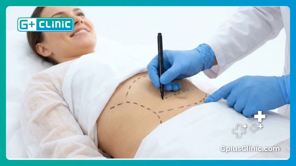 Surgeon marking the abdomen for Tummy Tuck in Turkey precision