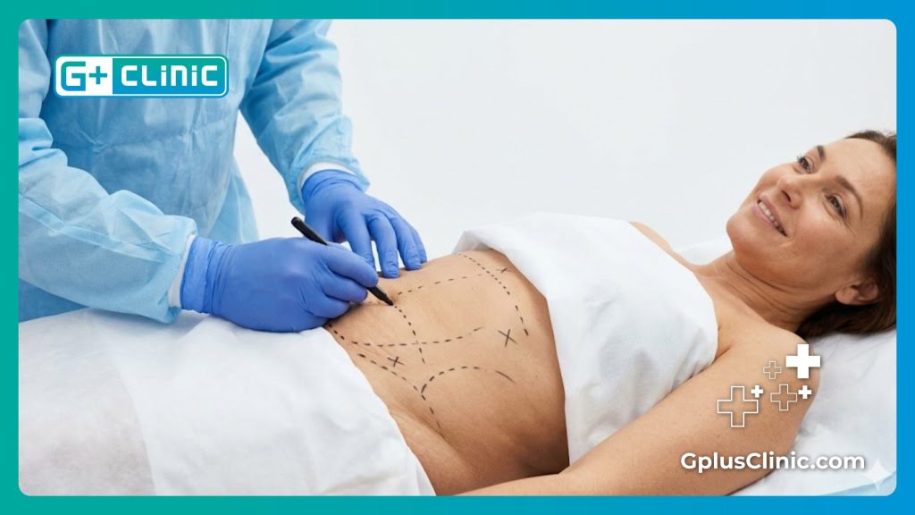 Surgeon marking stomach lines for liposuction procedure