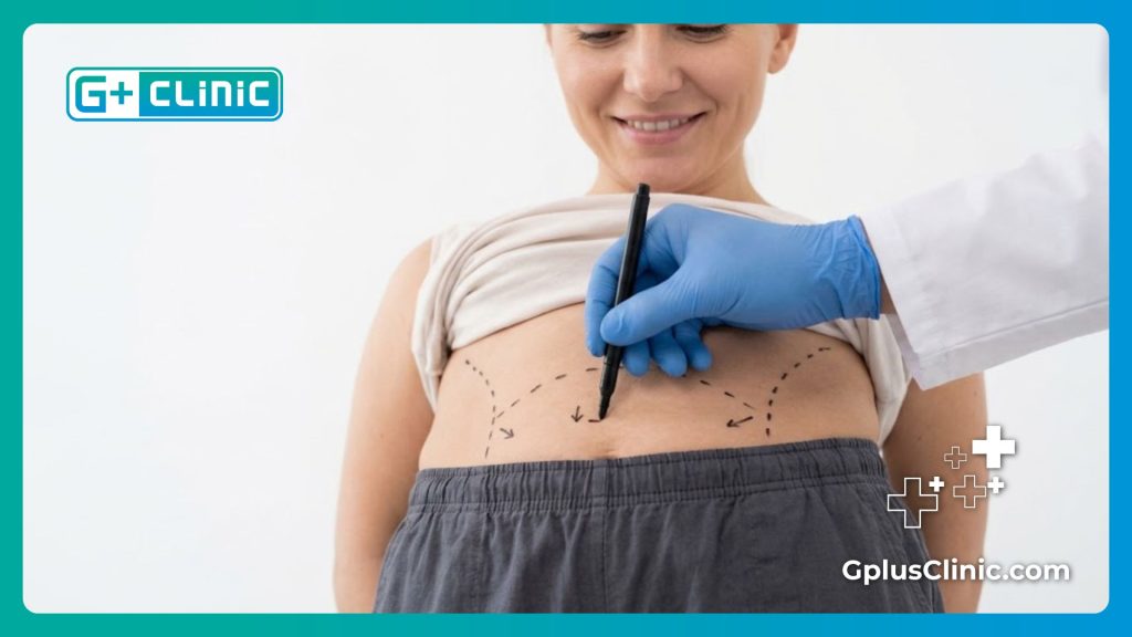 Cirujano plástico dibujando guías quirúrgicas precisas en el estómago de una paciente.