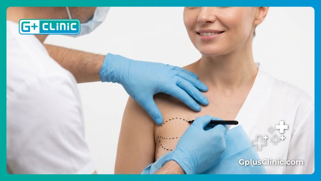 Precise surgical markings drawn prior to fat transfer breast augmentation procedure